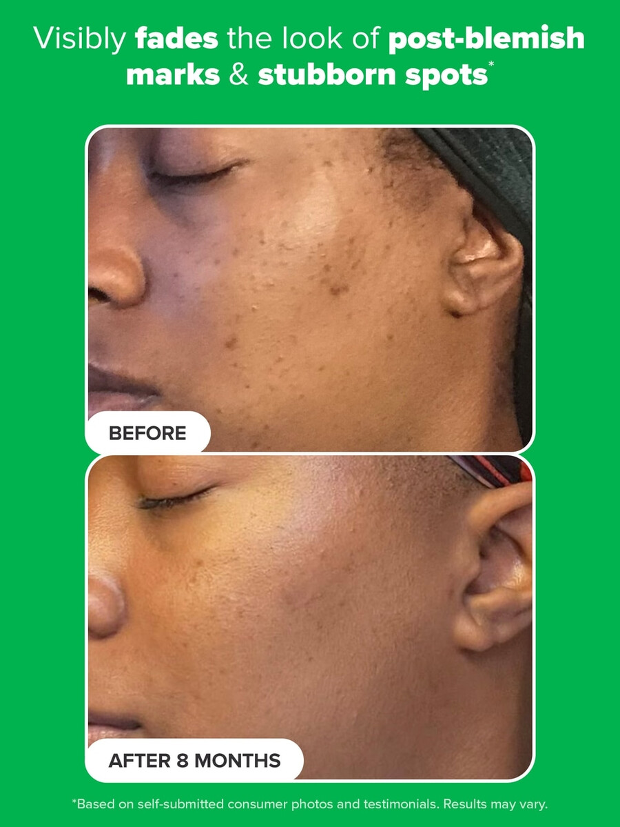 azelaic acid booster