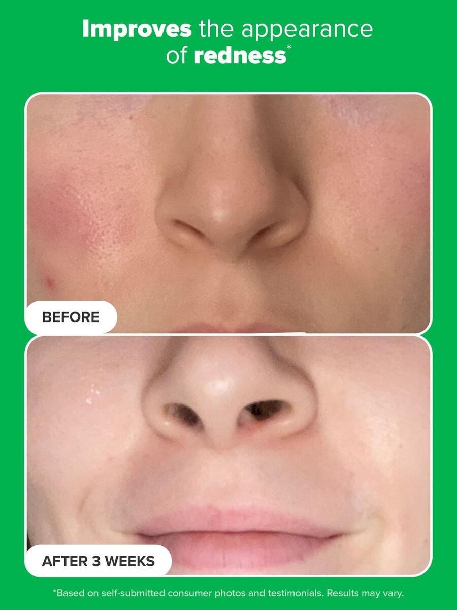 azelaic acid booster